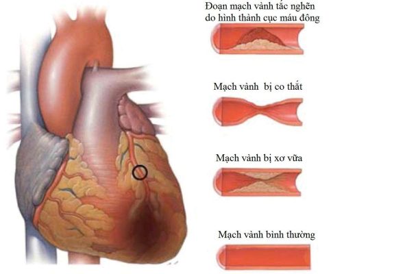 Các triệu chứng của thiếu máu cơ tim