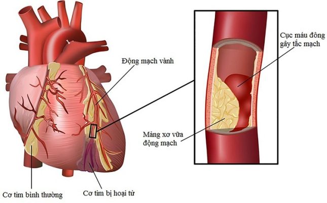 Những nguy cơ gây bệnh thiếu máu cơ tim